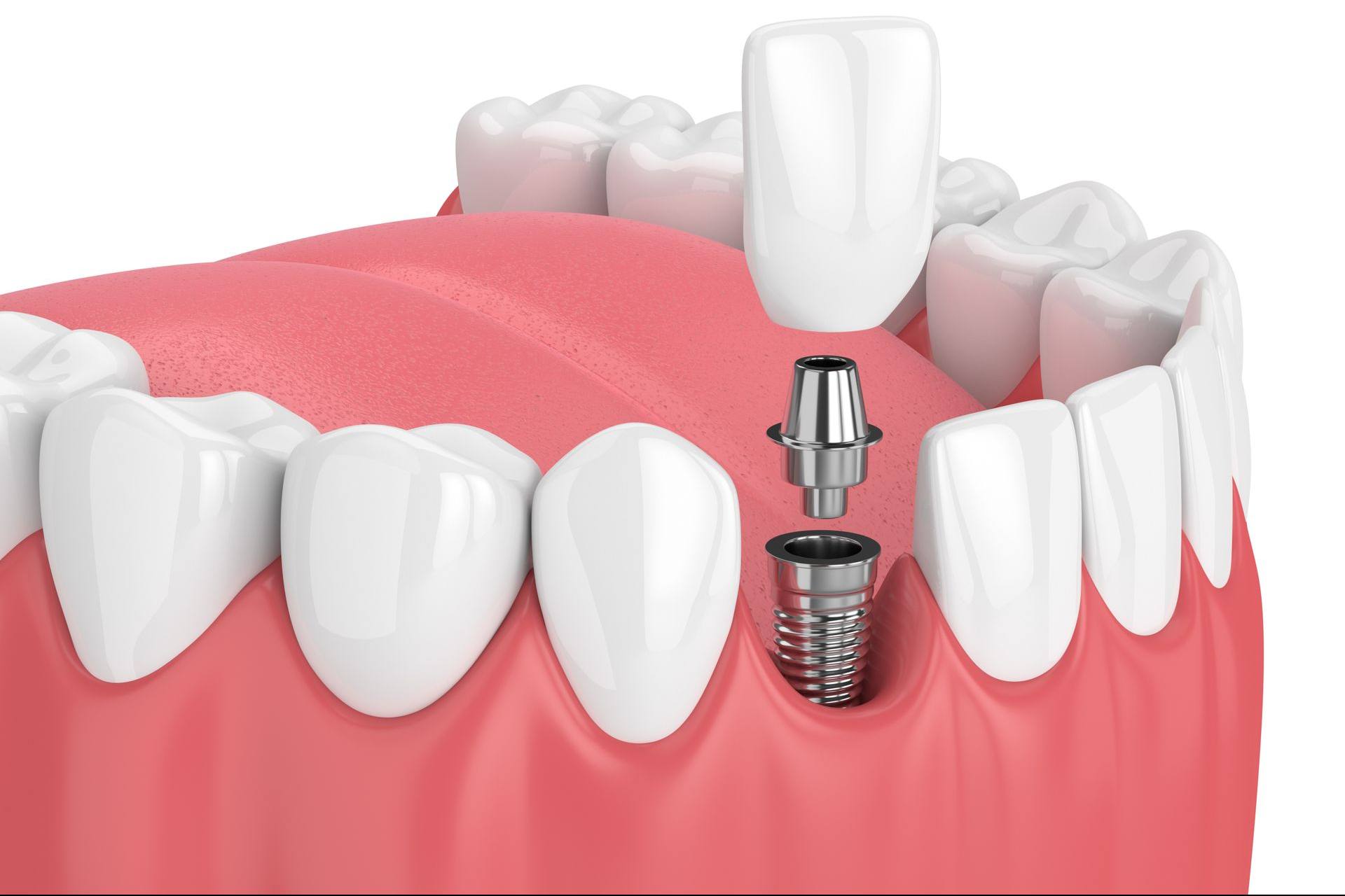 Model of a dental implant with abutment and crown placed between natural teeth