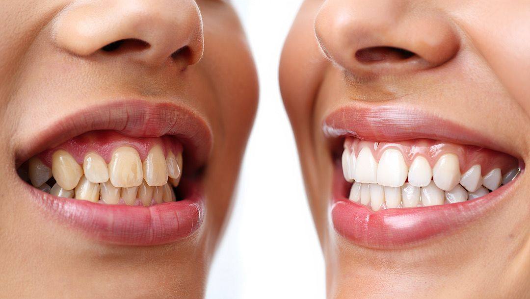 Side-by-side close-ups of teeth and gums before and after cleaning