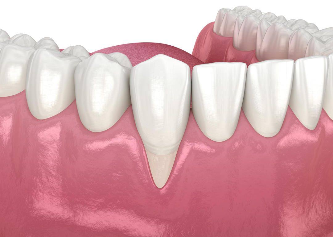 Illustration of a lower tooth with receding gums