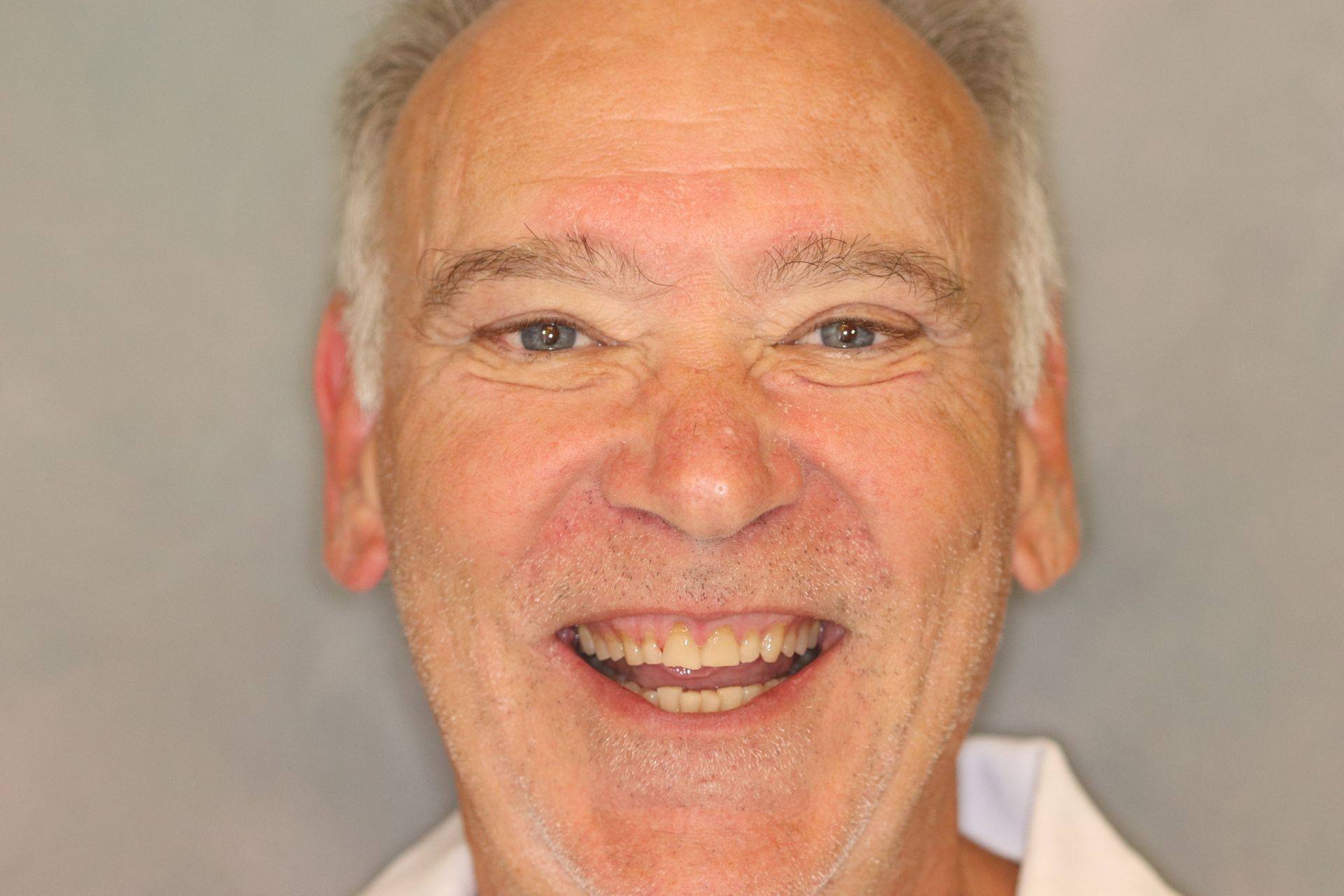 Case 1 before treatment: smiling man, front view