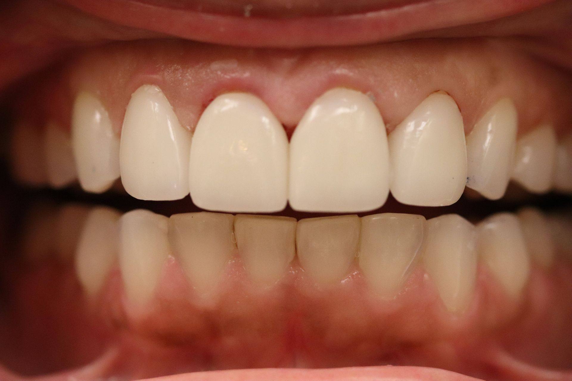 Case 2 after treatment: close-up of the front teeth after restoration
