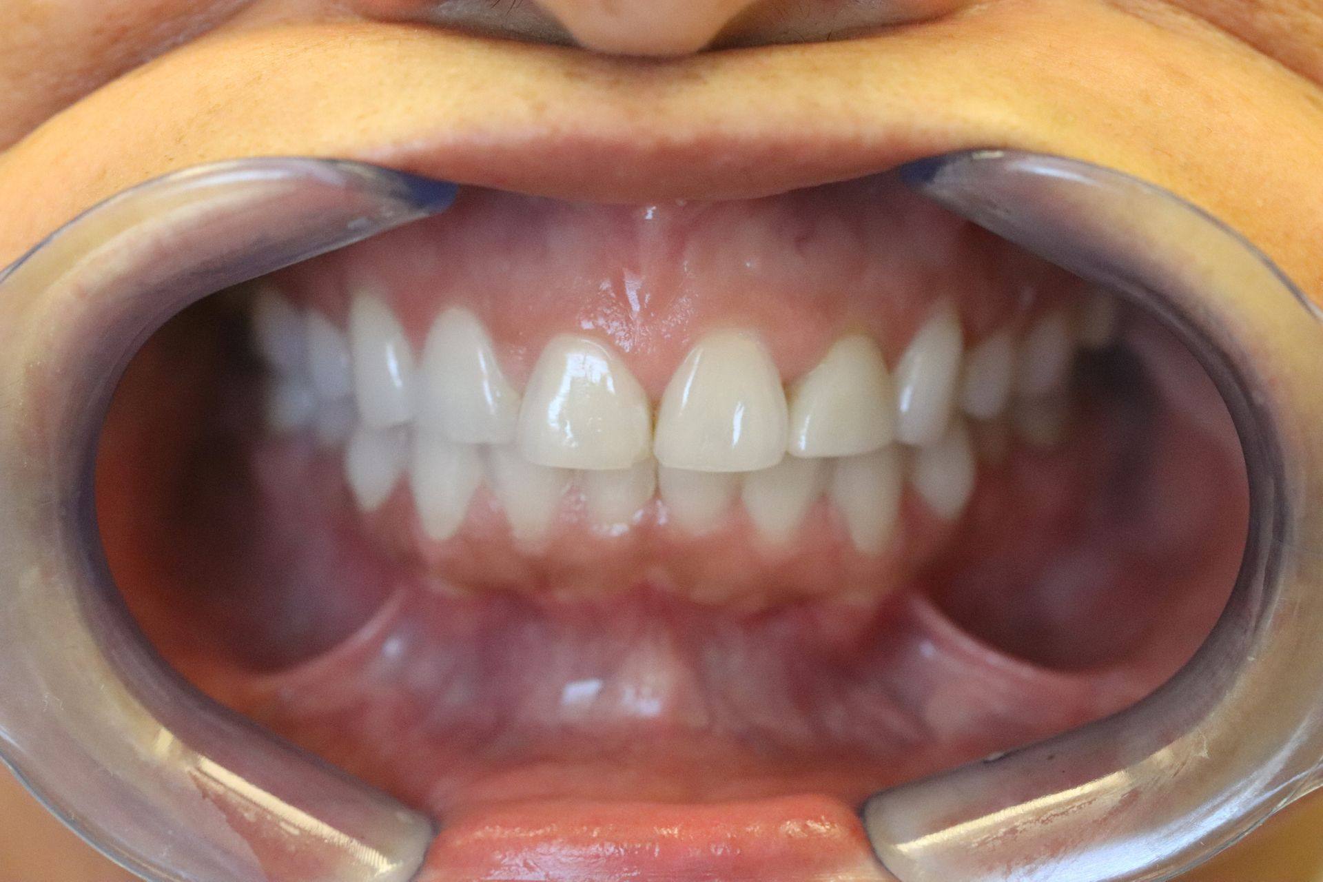 Case 2 before treatment: retracted view of the upper and lower front teeth