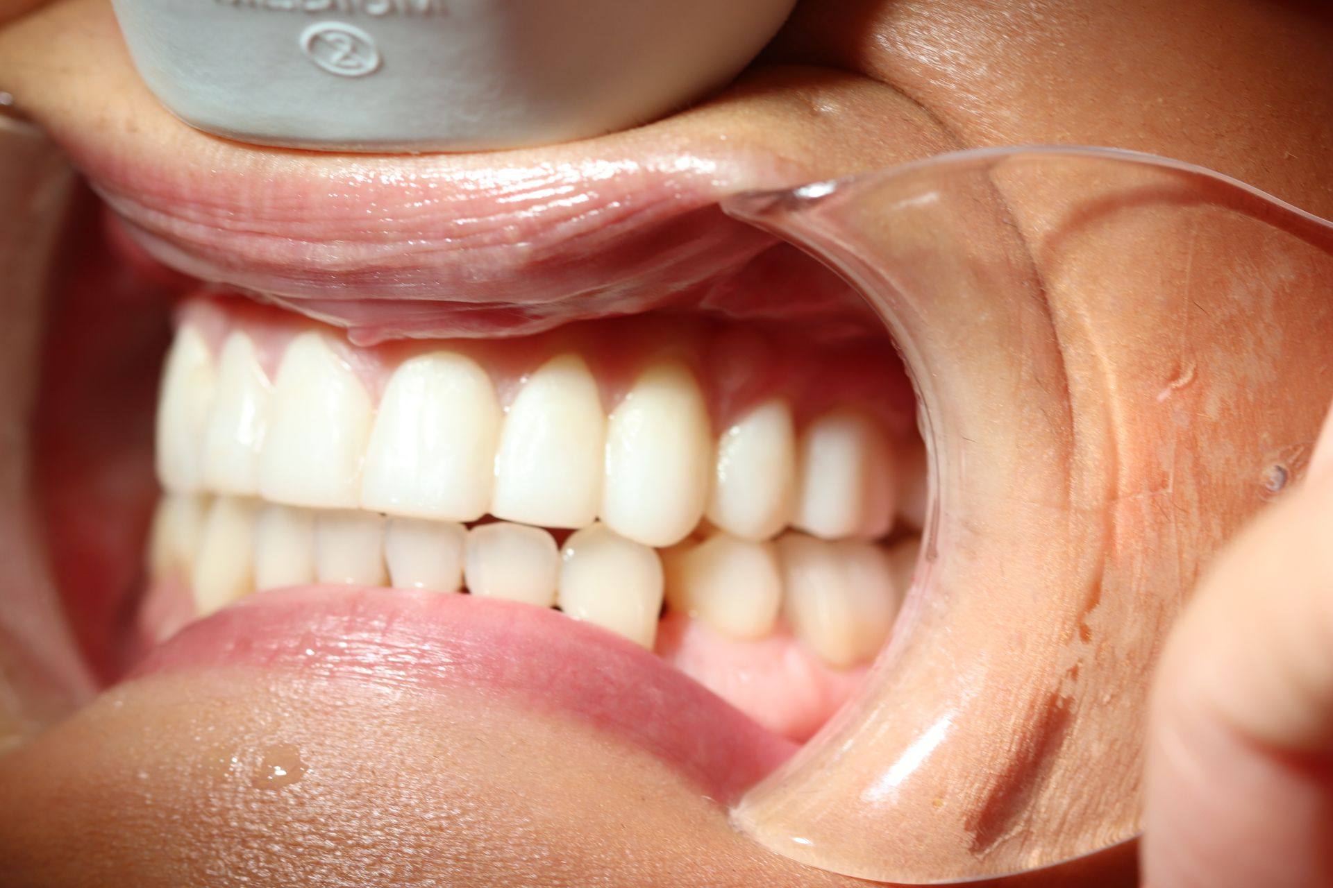 Case 4, second photo: side view of the upper and lower teeth