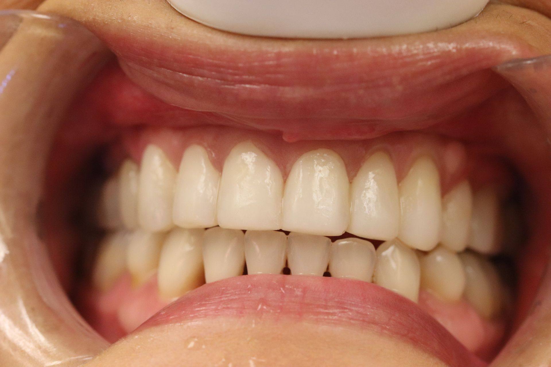Case 4, first photo: front view of the upper and lower teeth