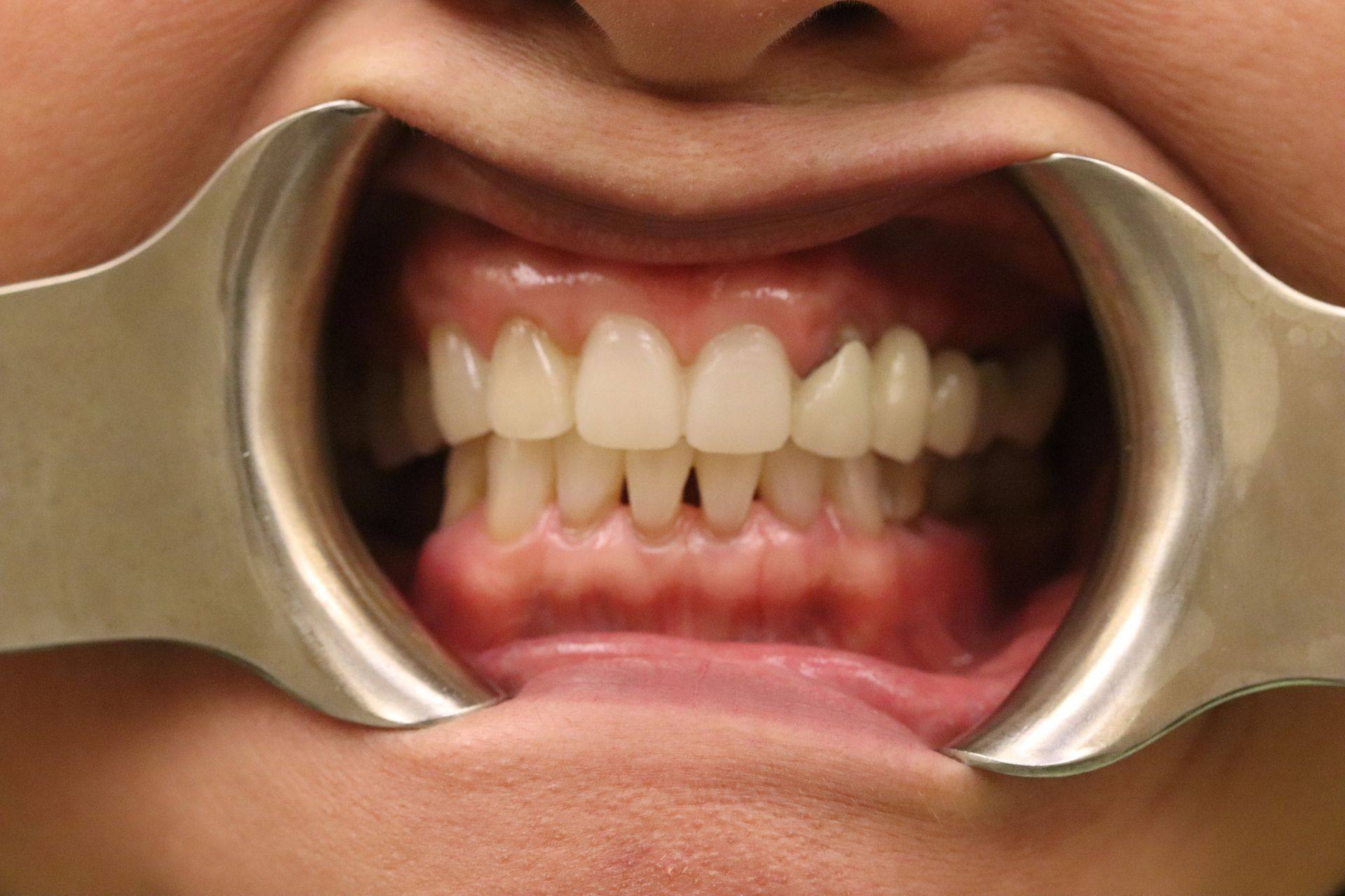 Case 5 after treatment: retracted view of the restored front teeth