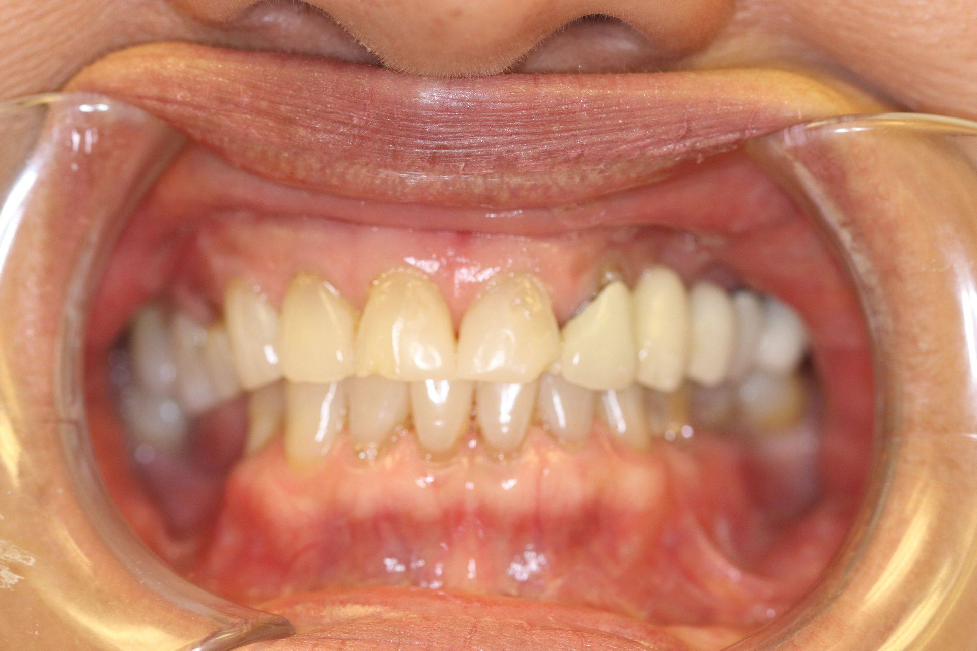 Case 5 before treatment: retracted view showing worn front teeth