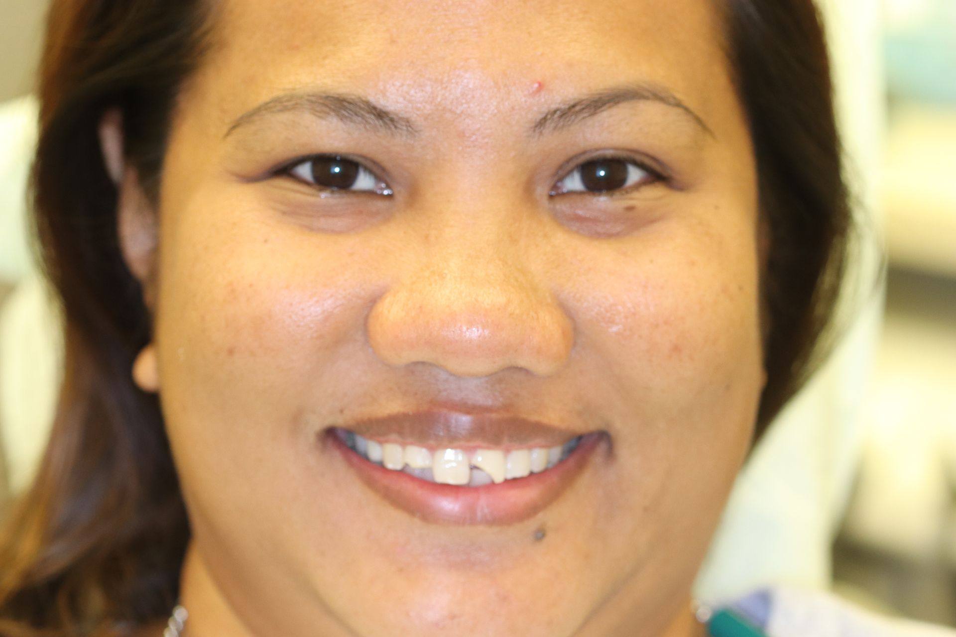 Case 6 before treatment: smiling woman with a gap between her front teeth