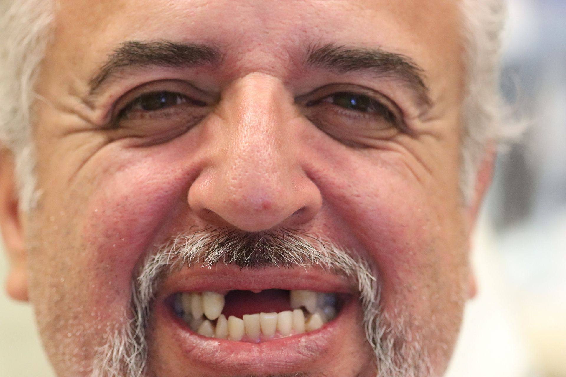 Case 7 before treatment: smiling man with missing upper front teeth
