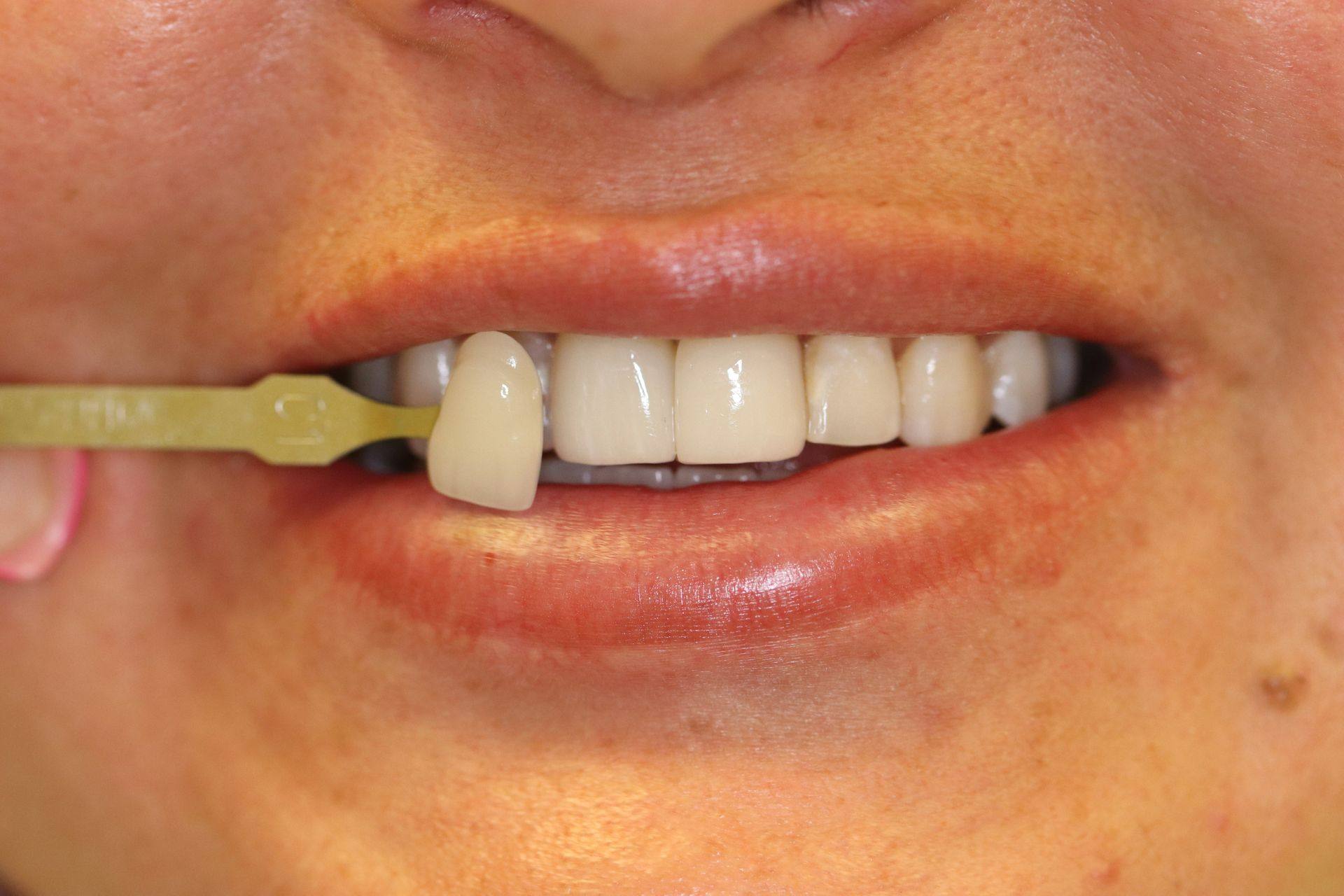 Case 8 after treatment: smile with a shade guide showing lighter teeth