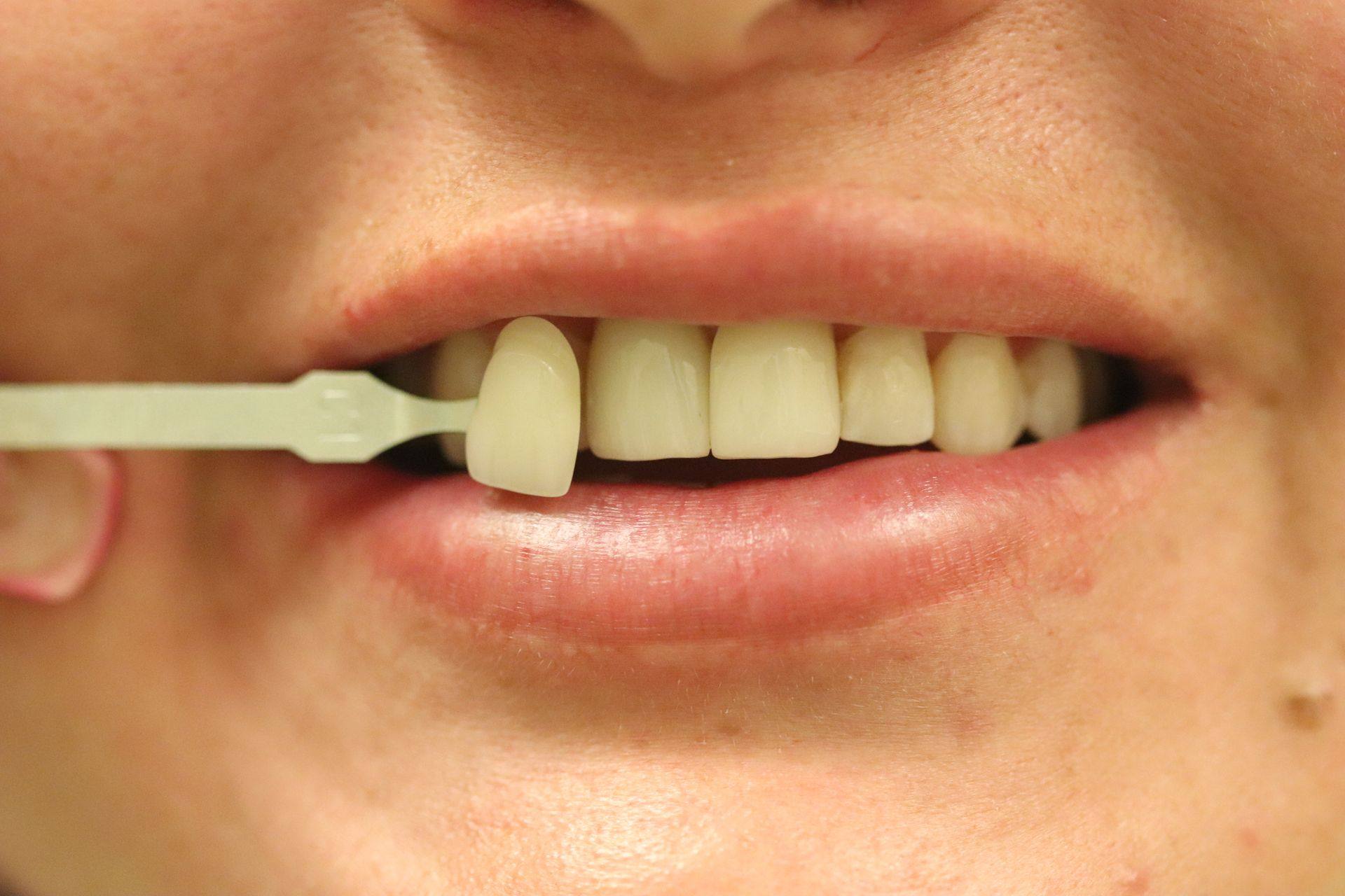 Case 8 before treatment: smile with a shade guide held beside the front teeth