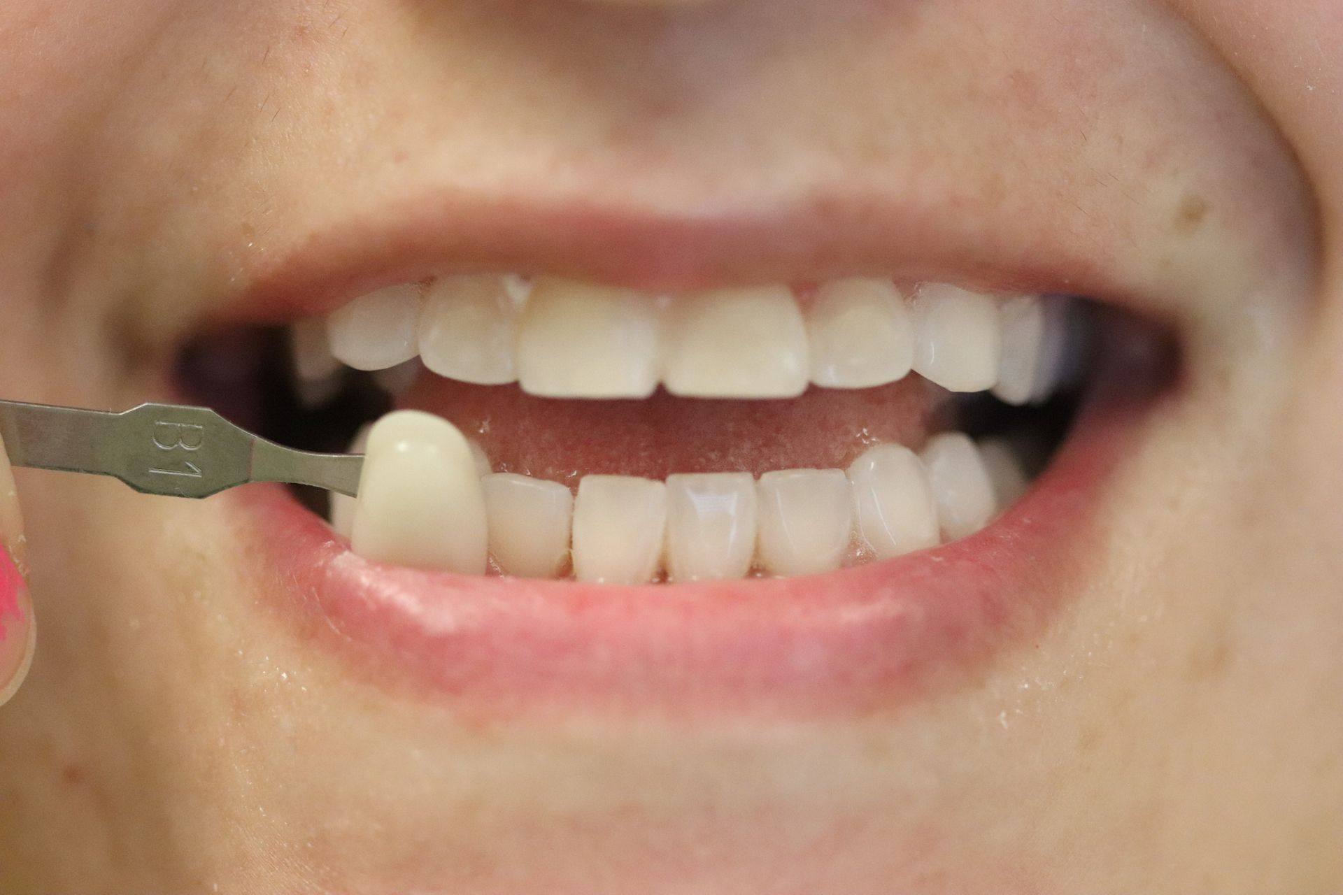 Case 9 after treatment: smile with a shade guide showing lighter teeth