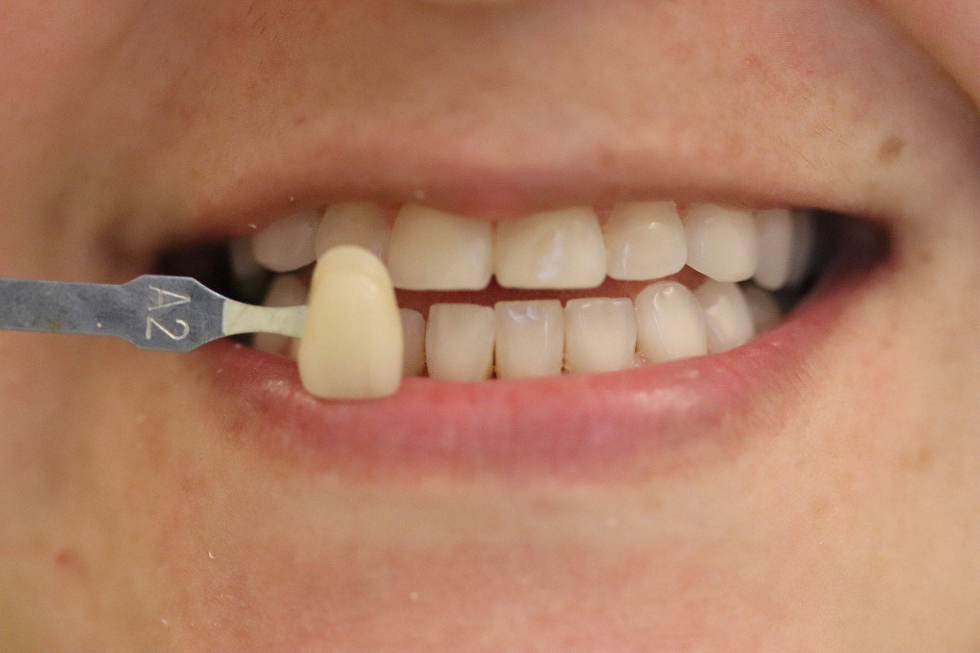 Case 9 before treatment: smile with a shade guide held beside the teeth