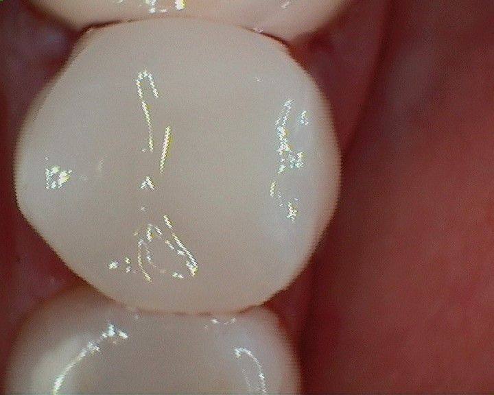 Case 10 after treatment: the same tooth restored with a tooth-colored crown