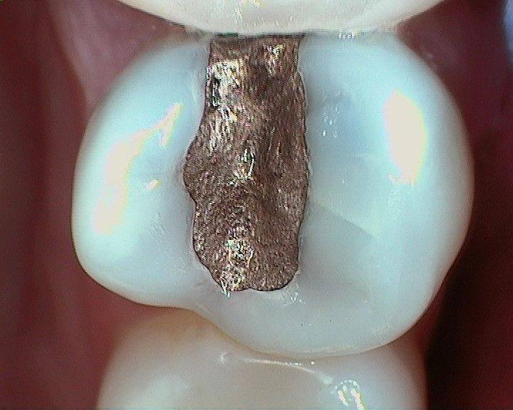 Case 10 before treatment: back tooth with a large silver filling