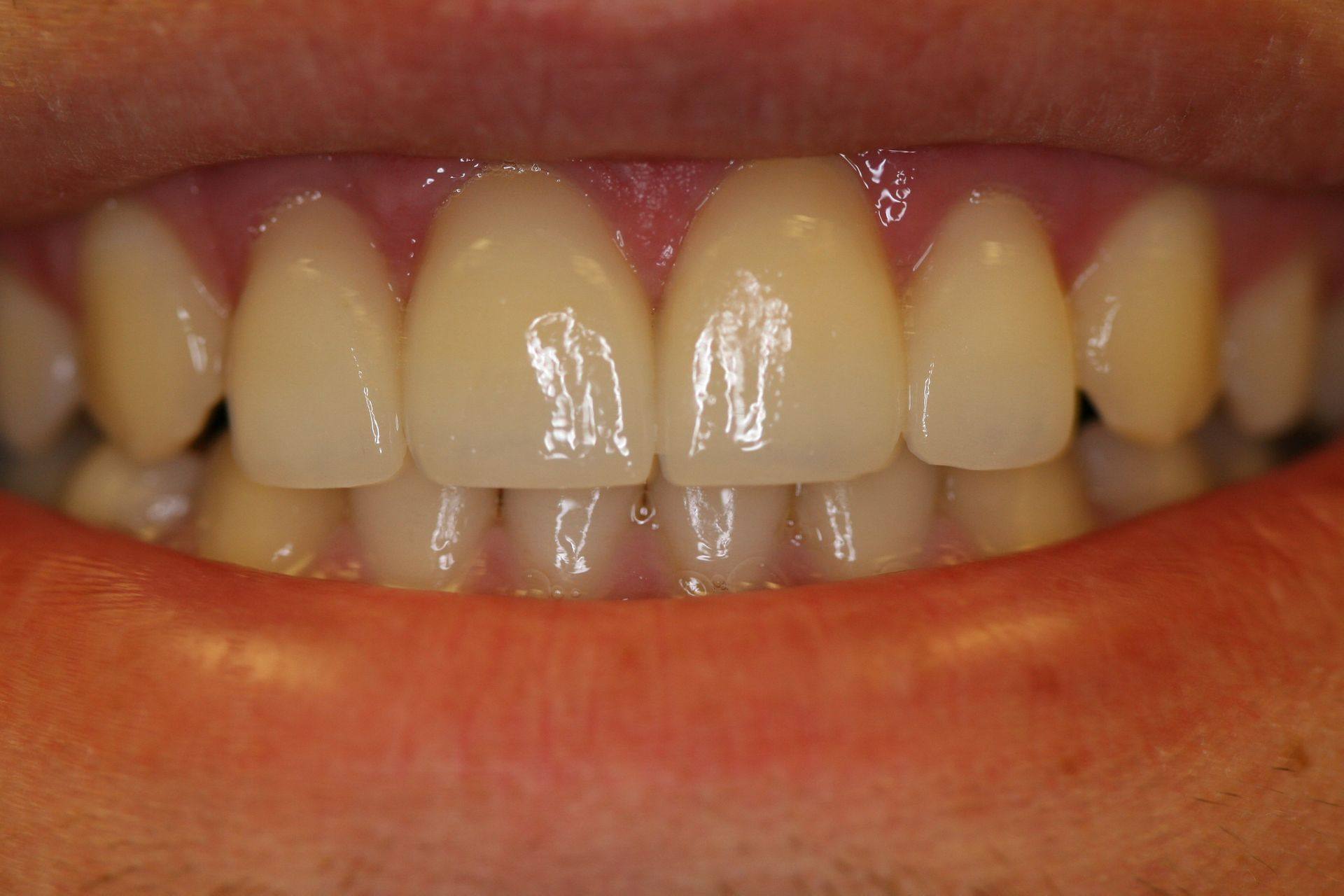 Case 11 after treatment: front teeth with the gaps closed