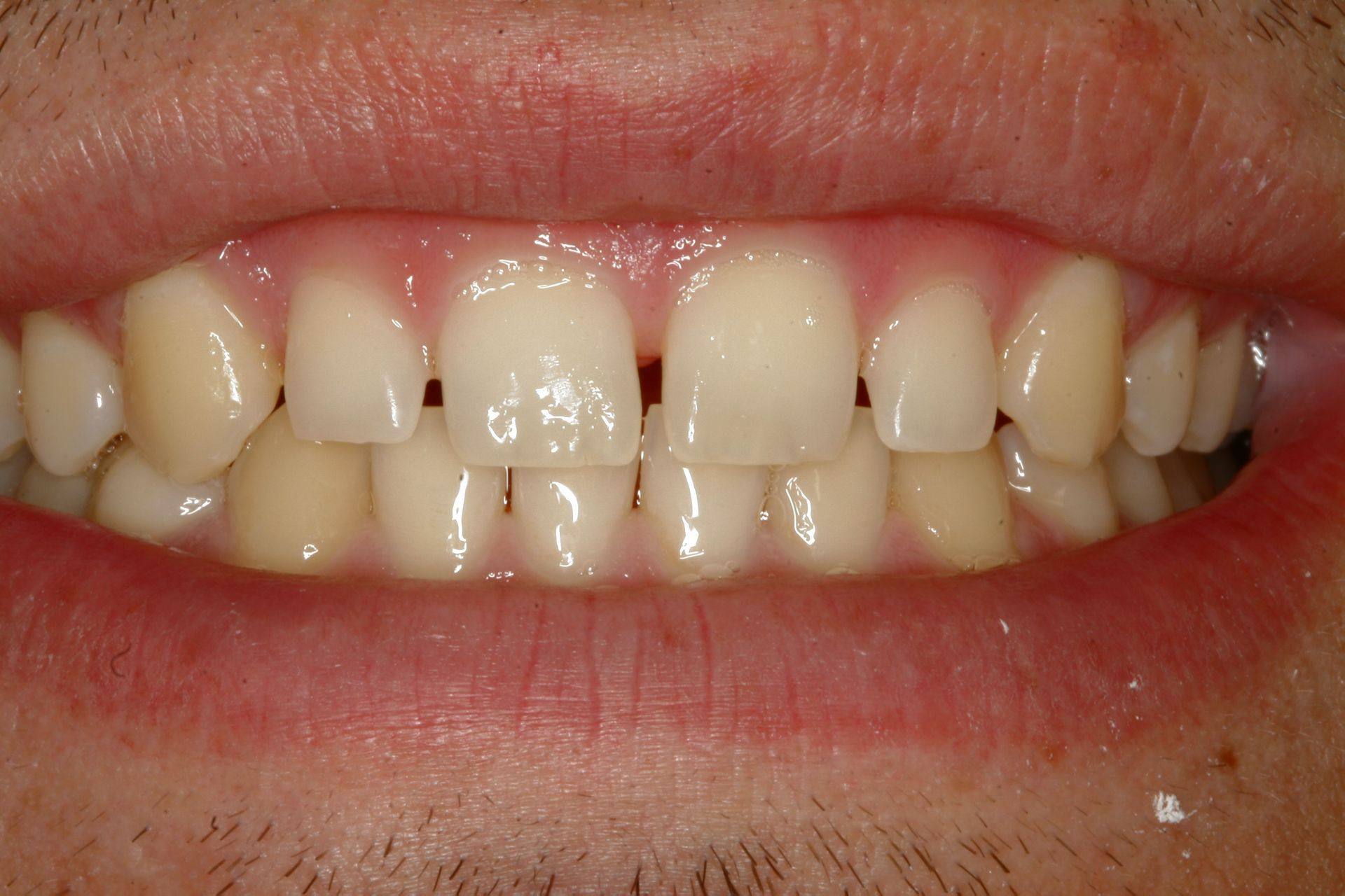 Case 11 before treatment: front teeth with small gaps