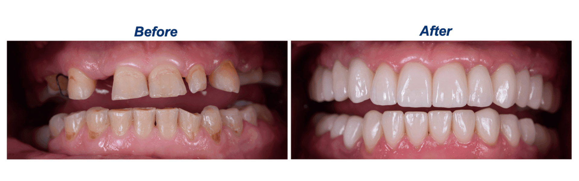 Before and after photos of front teeth restored at NEXT Dentistry